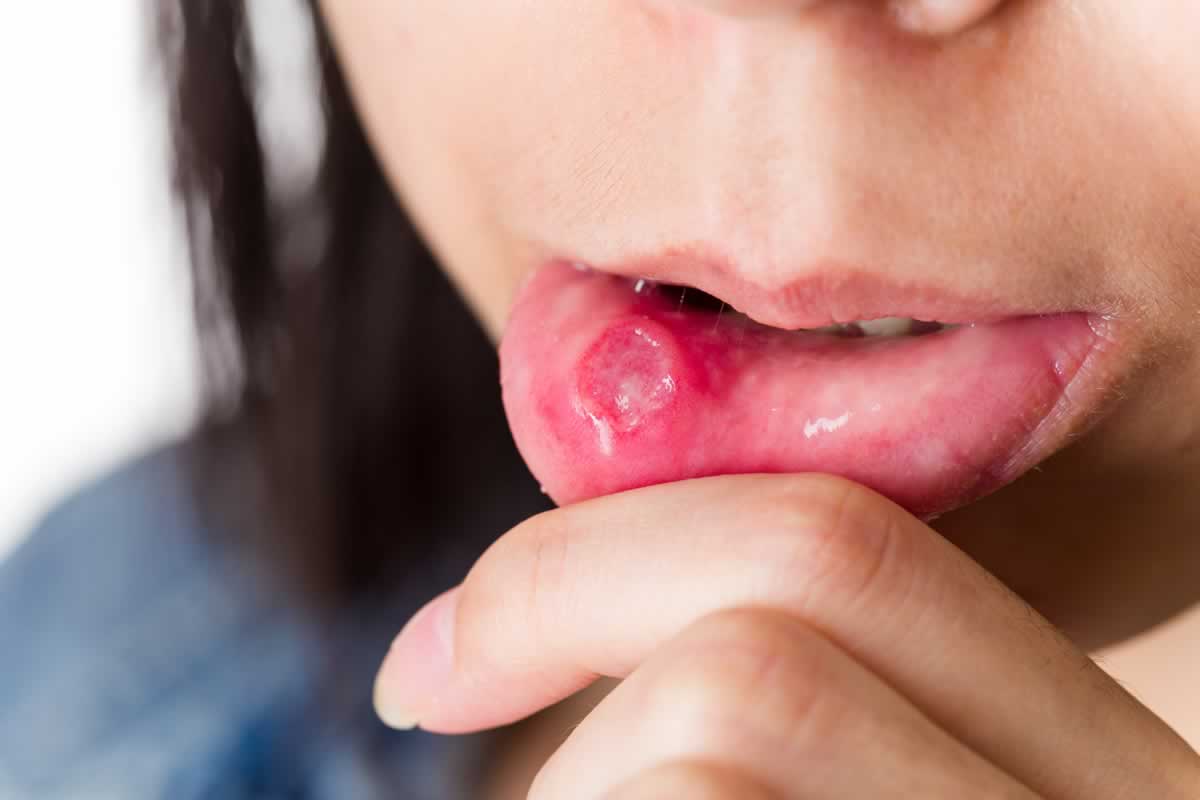 Afte e dieta: cause e rimedi alimentari